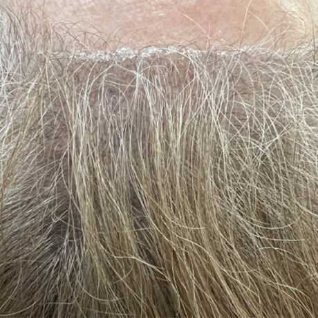 Scalp Micropigmentation case #10085
