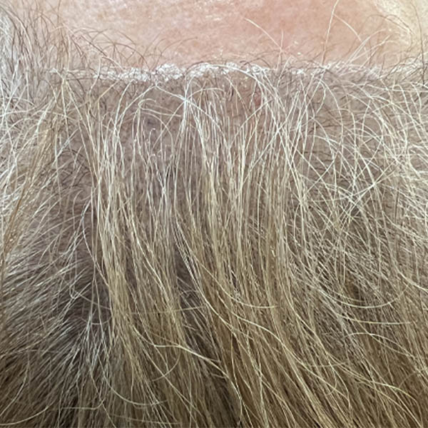 Scalp Micropigmentation case #10085