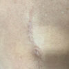 Scar/Skin Discoloration & Stretch Marks case #10153