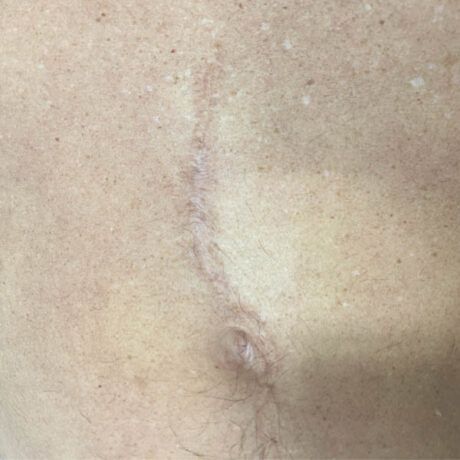 Scar/Skin Discoloration & Stretch Marks case #10153