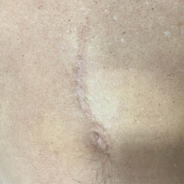 Scar/Skin Discoloration case #10153