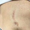 Scar/Skin Discoloration & Stretch Marks case #10153