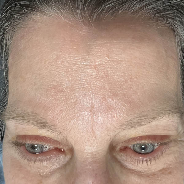 Scar/Skin Discoloration case #10150