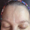 Scar/Skin Discoloration & Stretch Marks case #10150