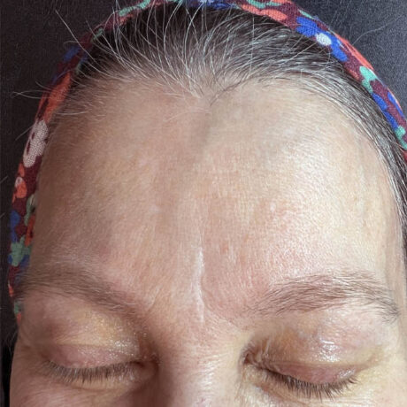 Scar/Skin Discoloration & Stretch Marks case #10150