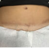 Scar/Skin Discoloration & Stretch Marks case #10147