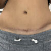 Scar/Skin Discoloration & Stretch Marks case #10147