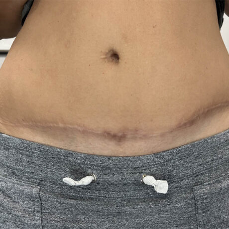 Scar/Skin Discoloration & Stretch Marks case #10147