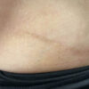 Scar/Skin Discoloration & Stretch Marks case #10144