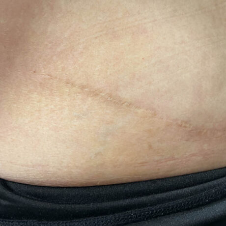 Scar/Skin Discoloration & Stretch Marks case #10144