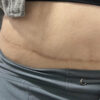 Scar/Skin Discoloration & Stretch Marks case #10144