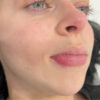 Scar/Skin Discoloration & Stretch Marks case #10141