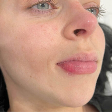 Scar/Skin Discoloration & Stretch Marks case #10141