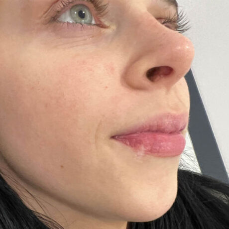 Scar/Skin Discoloration & Stretch Marks case #10141