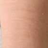 Scar/Skin Discoloration & Stretch Marks case #10138