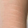 Scar/Skin Discoloration & Stretch Marks case #10138