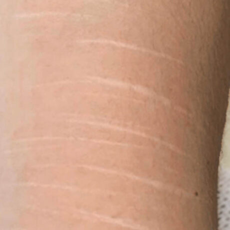 Scar/Skin Discoloration & Stretch Marks case #10138