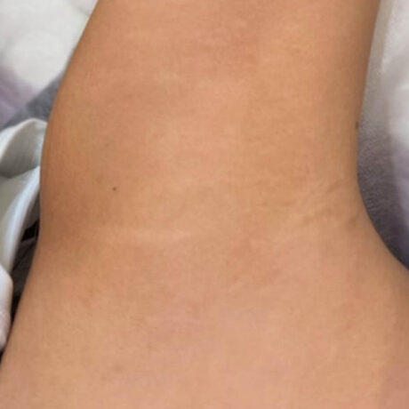 Scar/Skin Discoloration & Stretch Marks case #10135