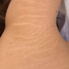 Scar/Skin Discoloration & Stretch Marks case #10135