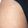 Scar/Skin Discoloration & Stretch Marks case #10132