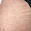 Scar/Skin Discoloration & Stretch Marks case #10132