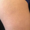 Scar/Skin Discoloration & Stretch Marks case #10129