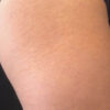 Scar/Skin Discoloration & Stretch Marks case #10129