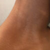 Scar/Skin Discoloration & Stretch Marks case #10126