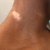 Scar/Skin Discoloration & Stretch Marks case #10126
