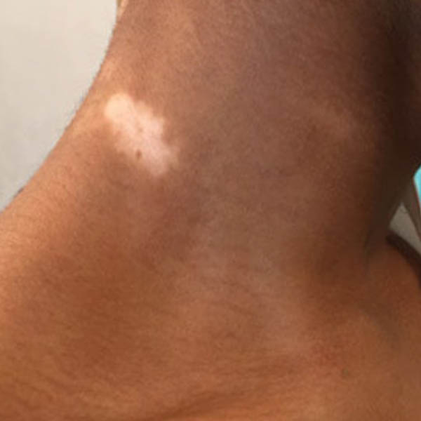 1_0037_vitiligo1 before.jpg