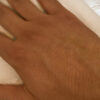 Scar/Skin Discoloration & Stretch Marks case #10115