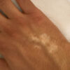 Scar/Skin Discoloration & Stretch Marks case #10115