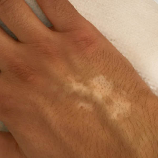 Scar/Skin Discoloration & Stretch Marks case #10115
