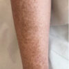 Scar/Skin Discoloration & Stretch Marks case #10123