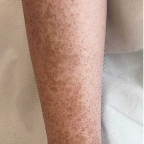 Scar/Skin Discoloration & Stretch Marks case #10123