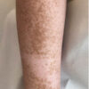 Scar/Skin Discoloration & Stretch Marks case #10123