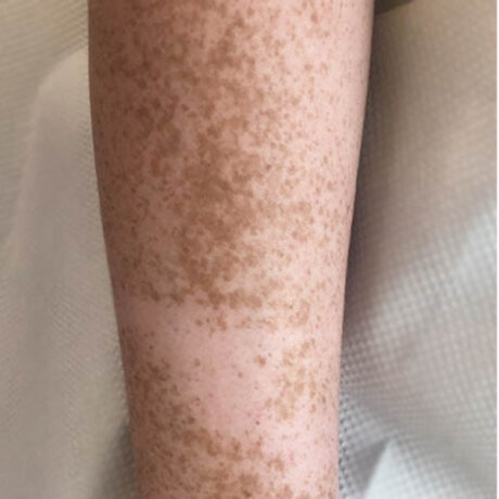 Scar/Skin Discoloration & Stretch Marks case #10123