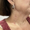Scar/Skin Discoloration & Stretch Marks case #13738