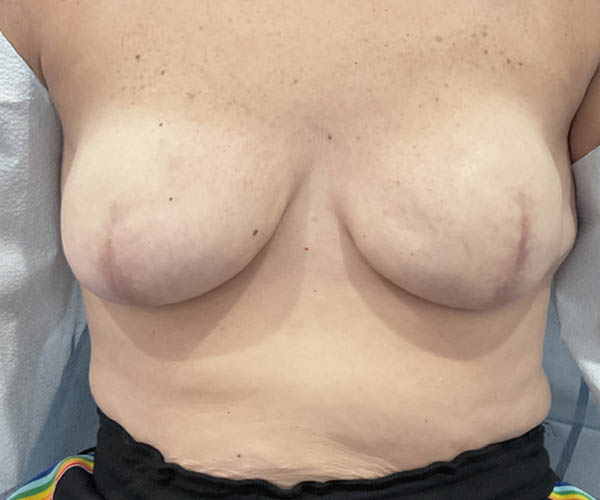 Nipple-Areola Complex (NAC) case #13724