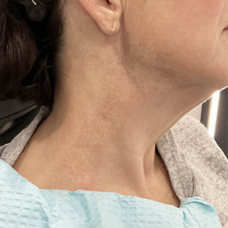 Scar/Skin Discoloration & Stretch Marks case #13738