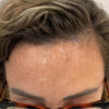 Scar/Skin Discoloration & Stretch Marks case #13844