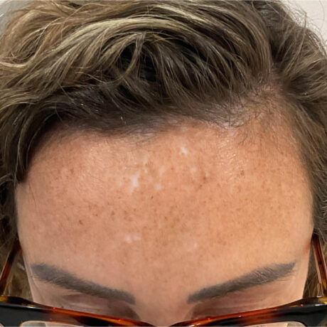 Scar/Skin Discoloration & Stretch Marks case #13844