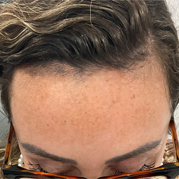 Scar/Skin Discoloration & Stretch Marks case #13844